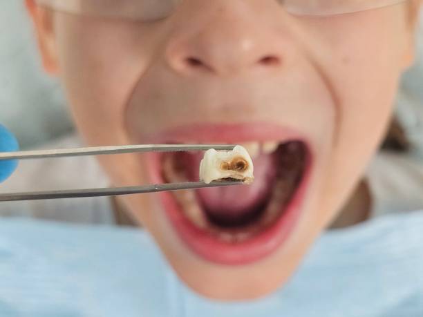 Best Emergency Treatment for Toothache in Monrovia, IN